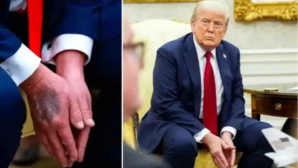 Şişlik ve morarma iddiaları sonrası Trump’ın sağlık raporu açıklandı