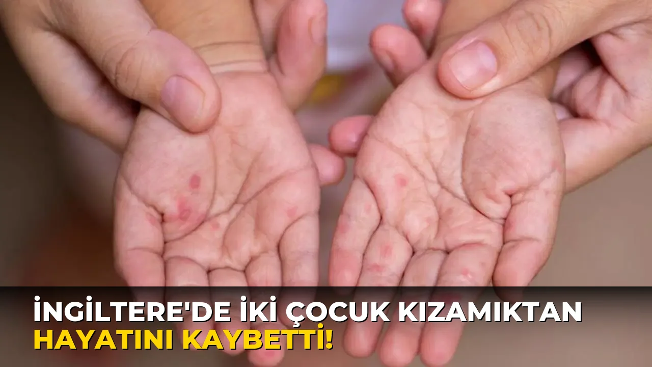 İngiltere'de iki Çocuk Kızamıktan Hayatını kaybetti!