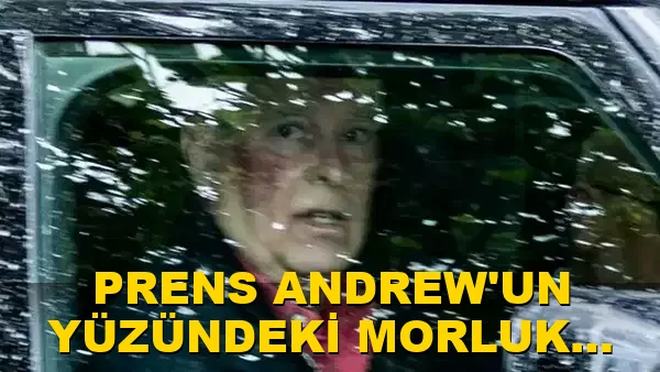 Prens Andrew'un yüzündeki morluk ne anlama geliyor?
