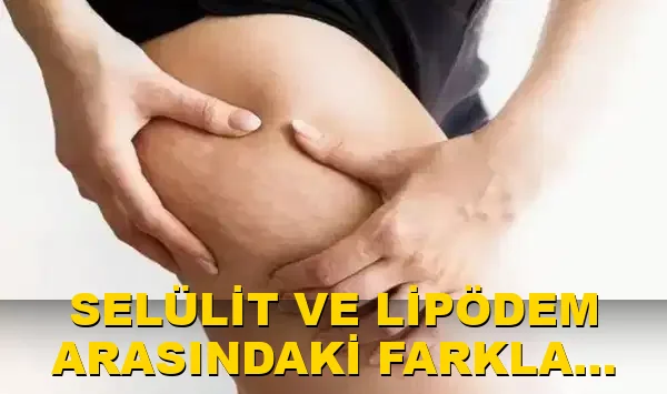 Selülit ve lipödem arasındaki farklar neler?