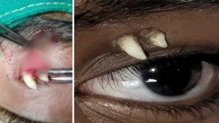 Tıp tarihinde sıra dışı vaka! 16 yaşındaki gencin gözünden diş çıktı