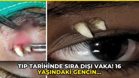 Tıp tarihinde sıra dışı vaka! 16 yaşındaki gencin gözünden diş çıktı